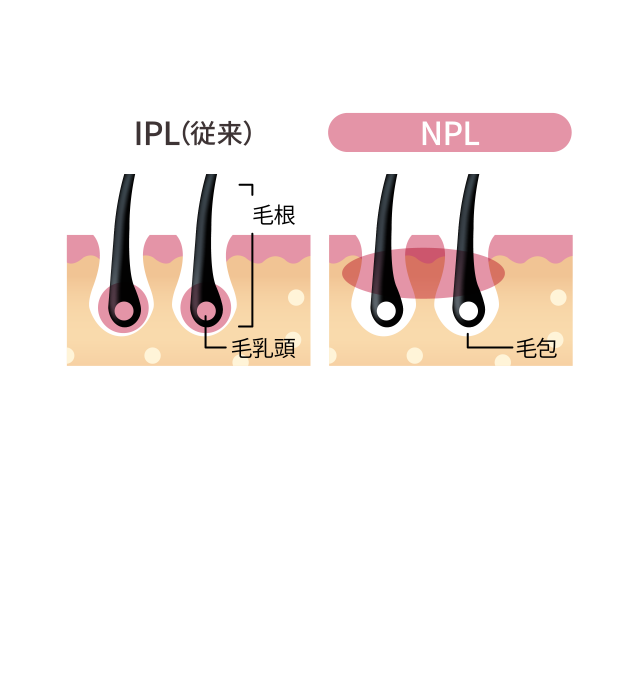 従来のIPLとの比較